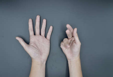 Unilateral Dupuytrenâs contracture in Asian young man. Unilateral hand deformity. Abnormal fingers flexion. Isolated on grey background.の写真素材