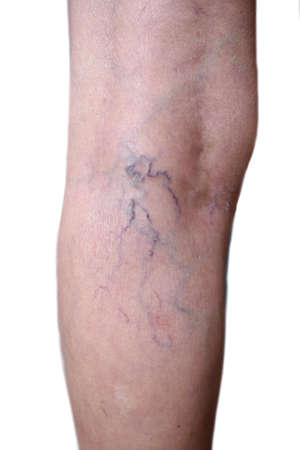 Southeast Asian, Myanmar old womanâs leg. Skin creases, loosen and thin skin and varicose veins show aging. Isolated on white background.の写真素材
