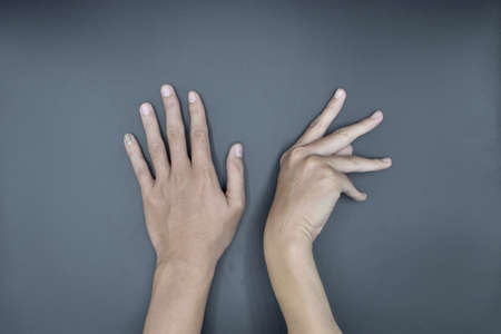 Unilateral Dupuytrenâs contracture in Asian young man. Unilateral hand deformity. Abnormal fingers flexion. Isolated on grey background.の写真素材
