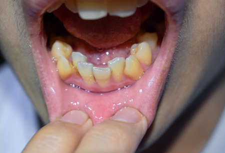 Stacked or overlapping teeth of Asian man. Also called crowded teeth. Closeup view.
