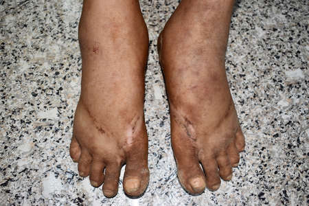 Bilateral edema of lower limbs. Swollen leg and foot of Asian woman.の写真素材