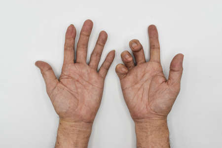 Ulnar claw hand compared to normal hand of Asian old man. also known as 'spinster's claw. develops due to ulnar nerve damage causing weakness of the lumbricals.の写真素材