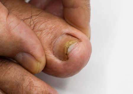 Damaged toenail. Fungal nail infection. Onychomycosis, also called Tinea unguium.の写真素材