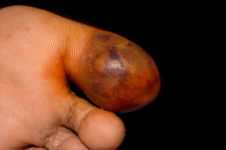 Abscess with surrounding cellulitis or Staphylococcal, Streptococcal skin infection at big toe of Asian Burmese male patient.の写真素材