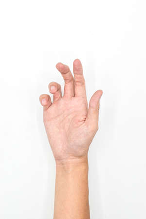 Unilateral Dupuytrenâs contracture in Asian young man. Unilateral hand abnormality. Abnormal fingers flexion.の写真素材