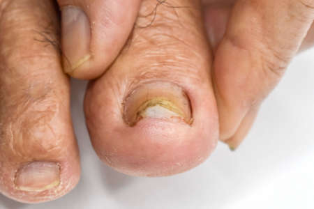 Damaged toenail. Fungal nail infection. Onychomycosis, also called Tinea unguium.の写真素材