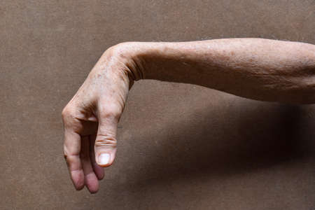 Radial nerve injury or wrist drop of Asian old man.の写真素材