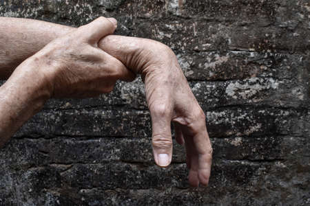 Radial nerve injury or wrist drop of Asian old man.