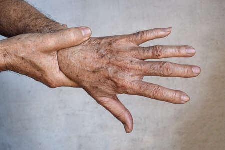 Age spots on hands of Asian elder man. They are brown, gray, or black spots and also called liver spots, senile lentigo, solar lentigines, or sun spots.の写真素材