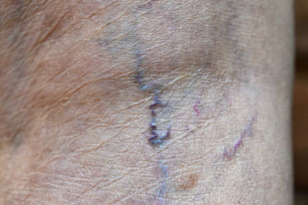 Prominent veins visible through the thin skin of Asian old woman.の写真素材