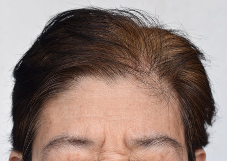 Skin creases or wrinkles at forehead of Southeast Asian, Myanmar or Burmese elder woman. Symptom of aging.の写真素材
