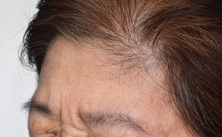 Skin creases or wrinkles at forehead of Southeast Asian, Myanmar or Burmese elder woman. Symptom of aging.の写真素材