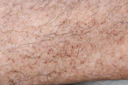 Age spots on leg of Asian elder man. Age spots are brown, gray, or black spots and also called liver...