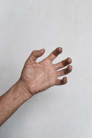 Volkmannâ€™s contracture in left upper limb of Southeast Asian elder man. It is a permanent...