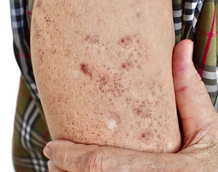 Age spots and white patches on arm of Asian elder man. These age spots are brown, gray, or black...