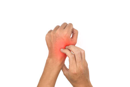 Asian young man scratching his hand. Concept of itchy skin diseases such as scabies, fungal...