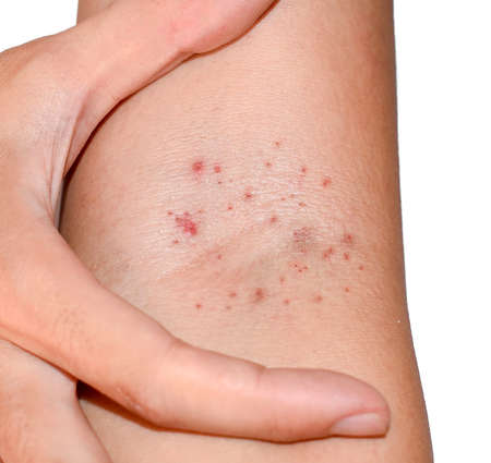 Multiple red spots in cubital fossa showing that Hessâ€™s test positive. Dengue hemorrhagic...