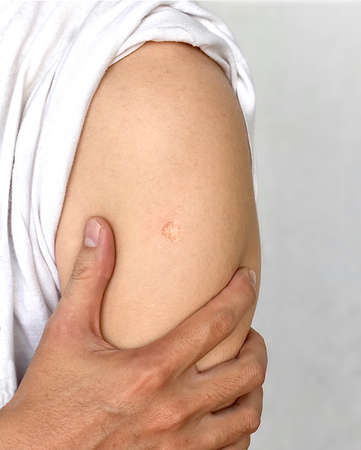 BCG or TB vaccine scar mark at the arm of Southeast Asian man.
