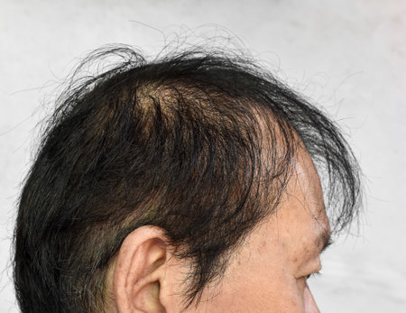 Thinning or sparse hair, male pattern hair loss in Southeast Asian, Chinese elder man.の写真素材