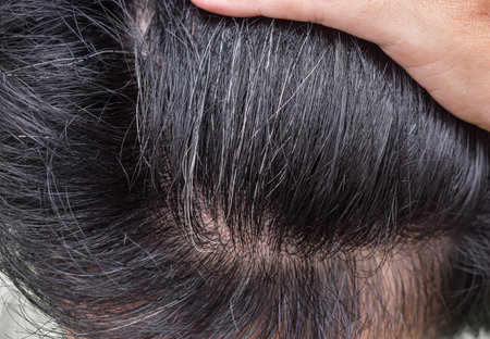 Premature hair whitening. Early aging. Grey colored changes of hair in Asian young man.の写真素材