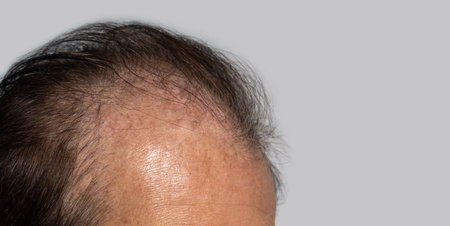 Bald head of Asian elder man. Concept of male pattern hair loss or sparse hair.の写真素材