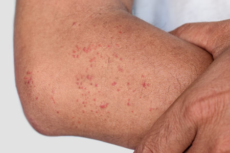 Multiple itchy mosquito or insect bite wheals; red spots on the forearm of Southeast Asian, Chinese...