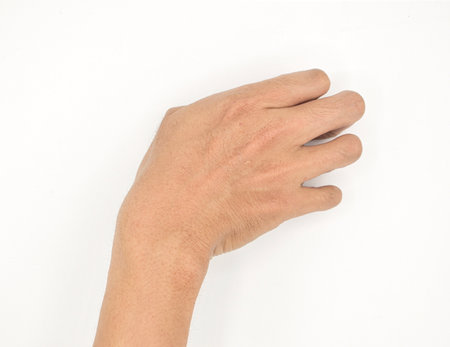 Cerebral palsy hand in Southeast Asian young male patient. Typically seen in hemiplegia and quadriplegia. Wrist joint flexion with ulnar deviation.の写真素材
