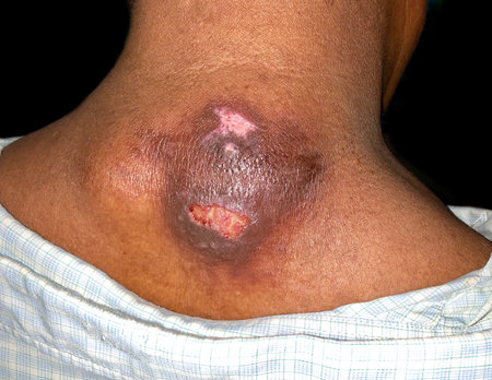 Large abscess with surrounding cellulitis or Staphylococcal, Streptococcal skin infection at the neck of Asian male patient.の写真素材