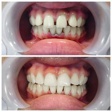 Before and after fixation for huge gap between the front teeth or incisors, diastema.の写真素材