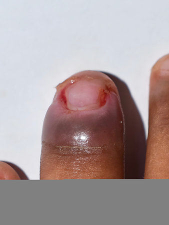 A finger with a severe case of paronychia, showcasing swelling and redness near the nailの写真素材