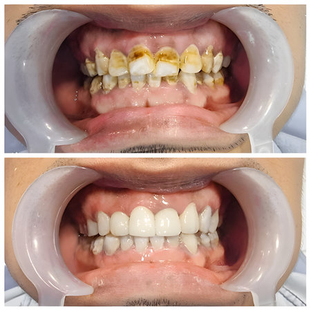 Before and after scaling and polishing treatment for tobacco stains on the teethの写真素材