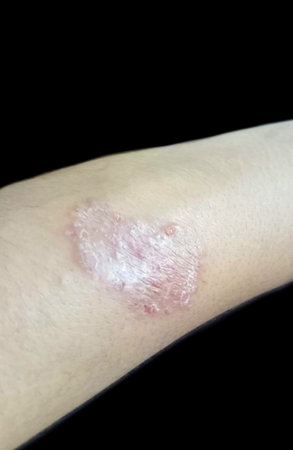 Dermatophytosis, also known as tinea and ringworm, a fungal infection of the skin.の写真素材
