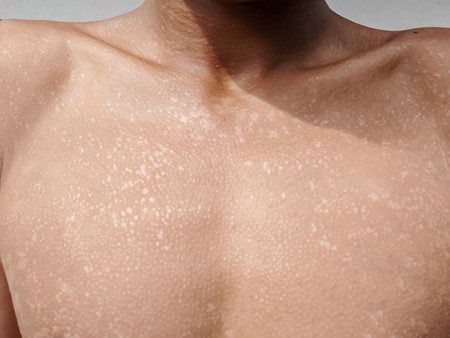 Tinea Versicolor on the chest, characterized by small, white patches of hypopigmentation.の写真素材