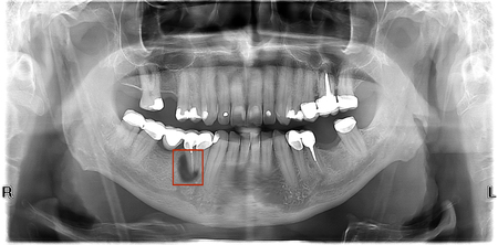 Panoramic dental x-ray of human teeth. Two teeth darker roots with inflammation (gangrene) in the red frame.の写真素材
