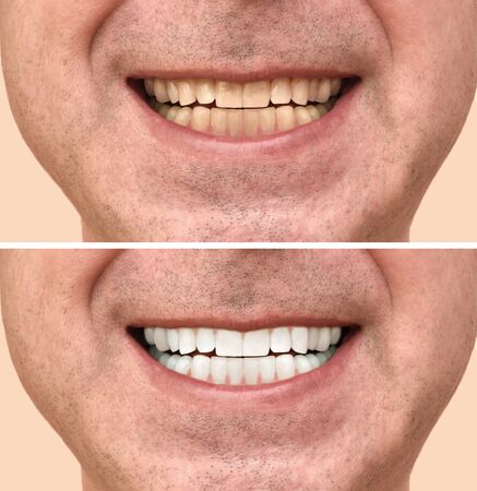 Teeth of a man before and after dental treatmentの写真素材