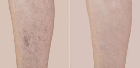 Part of a leg of a middle-aged woman with varicose veins and capillaries before and after medical treatment. Close-up.の写真素材
