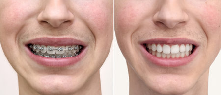 Teeth of a teenage boy before and after dental braces treatment. Close-up. Health care and medical concept.の写真素材