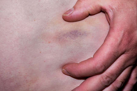 Big black bruise on the bodyの写真素材