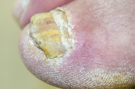 Toenails with common fungal infection.の写真素材