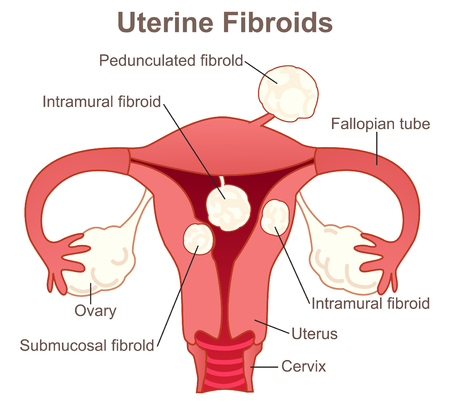Uterine fibroids growth positionのイラスト素材
