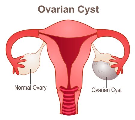 Ovarian Cyst, a gynecologic medical conditionのイラスト素材
