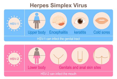 Herpes Simplex Virusのイラスト素材