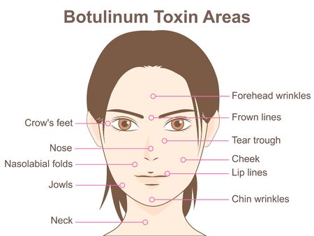 Botulinum Toxin Areasのイラスト素材