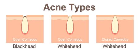 Acne typesのイラスト素材