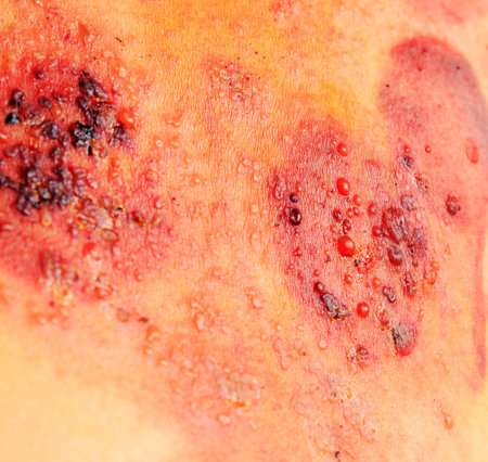 Skin disease - multiple herpes, closeup of photo