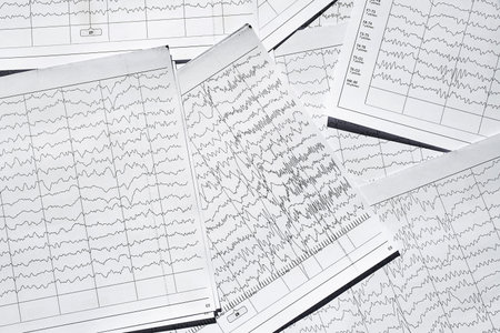 Electroencephalogram diagnostic rezults after epilepsy. Brain wave patterns on EEG.