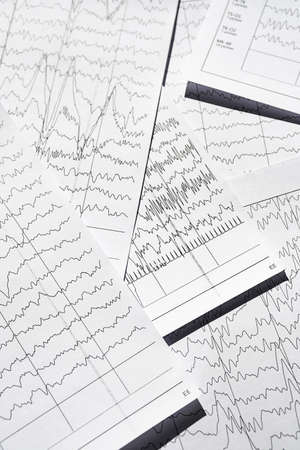 Electroencephalogram diagnostic rezults after epilepsy. Brain wave patterns on EEG.の写真素材