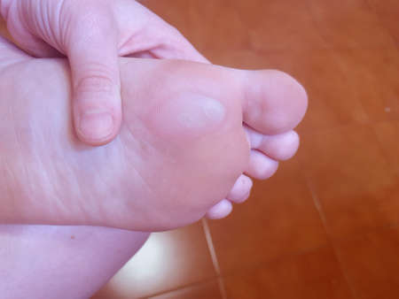 Close up of calluses. Painful corn on foot.の写真素材