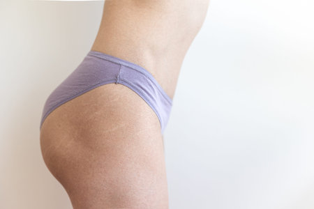 Female body with stretch marks on the buttocks, stretch marks on the skin after losing weight, postpartum skin changesの写真素材