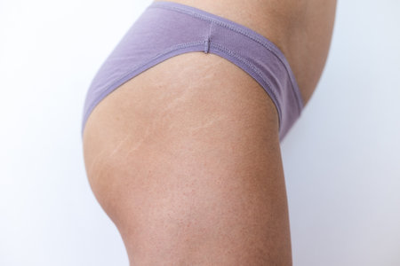 Female body with stretch marks on the buttocks, stretch marks on the skin after losing weight, postpartum skin changesの写真素材